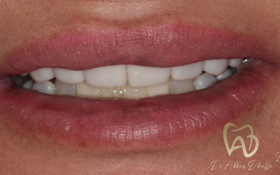 veneers-after1-2x