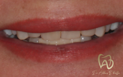 veneers-before1-2x