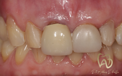 composite-after1