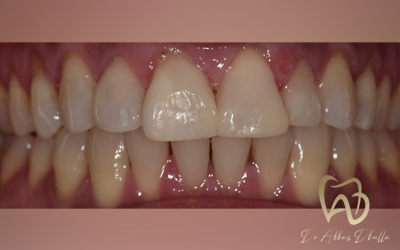 composite-after5