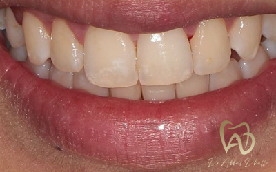 invisalign-after1