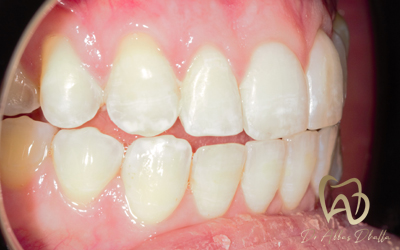 invisalign-after5