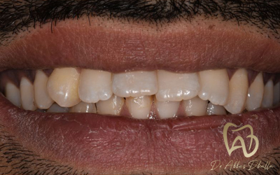 invisalign-before2