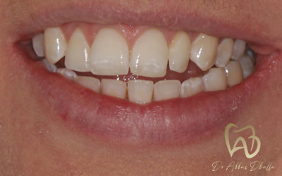 invisalign-before3