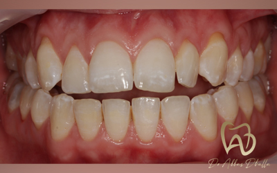 invisalign-before4