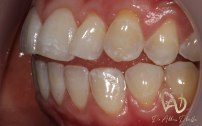 invisalign-before6