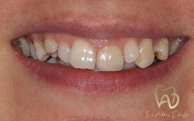 veneers-before2