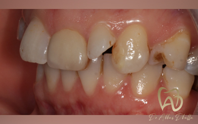 veneers-before5