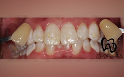 whitening-fluorosis-after1