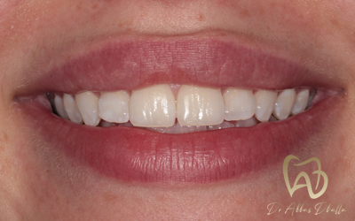 whitening-fluorosis-after2