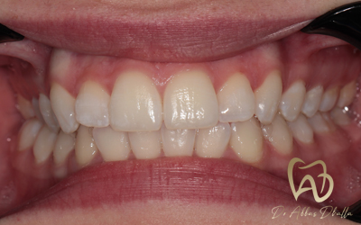 whitening-fluorosis-after3