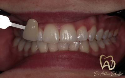 whitening-fluorosis-after4