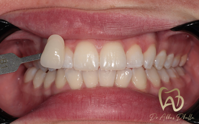 whitening-fluorosis-after5