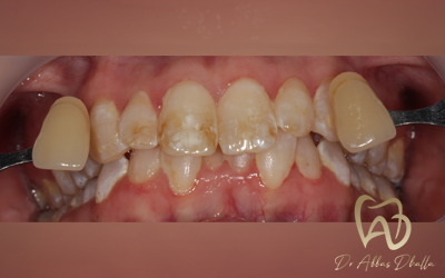 whitening-fluorosis-before1