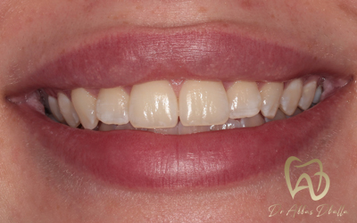 whitening-fluorosis-before2