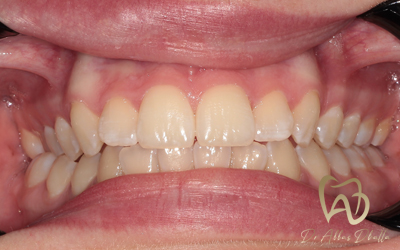 whitening-fluorosis-before3