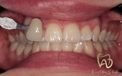 whitening-fluorosis-before4