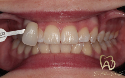 whitening-fluorosis-before5